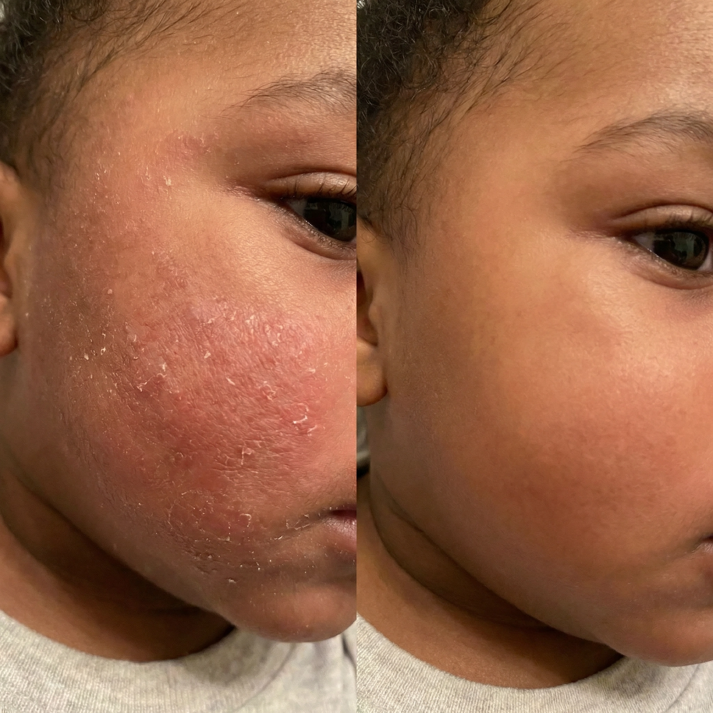DermaCalm Bébé™ – Crème Réparatrice Intense