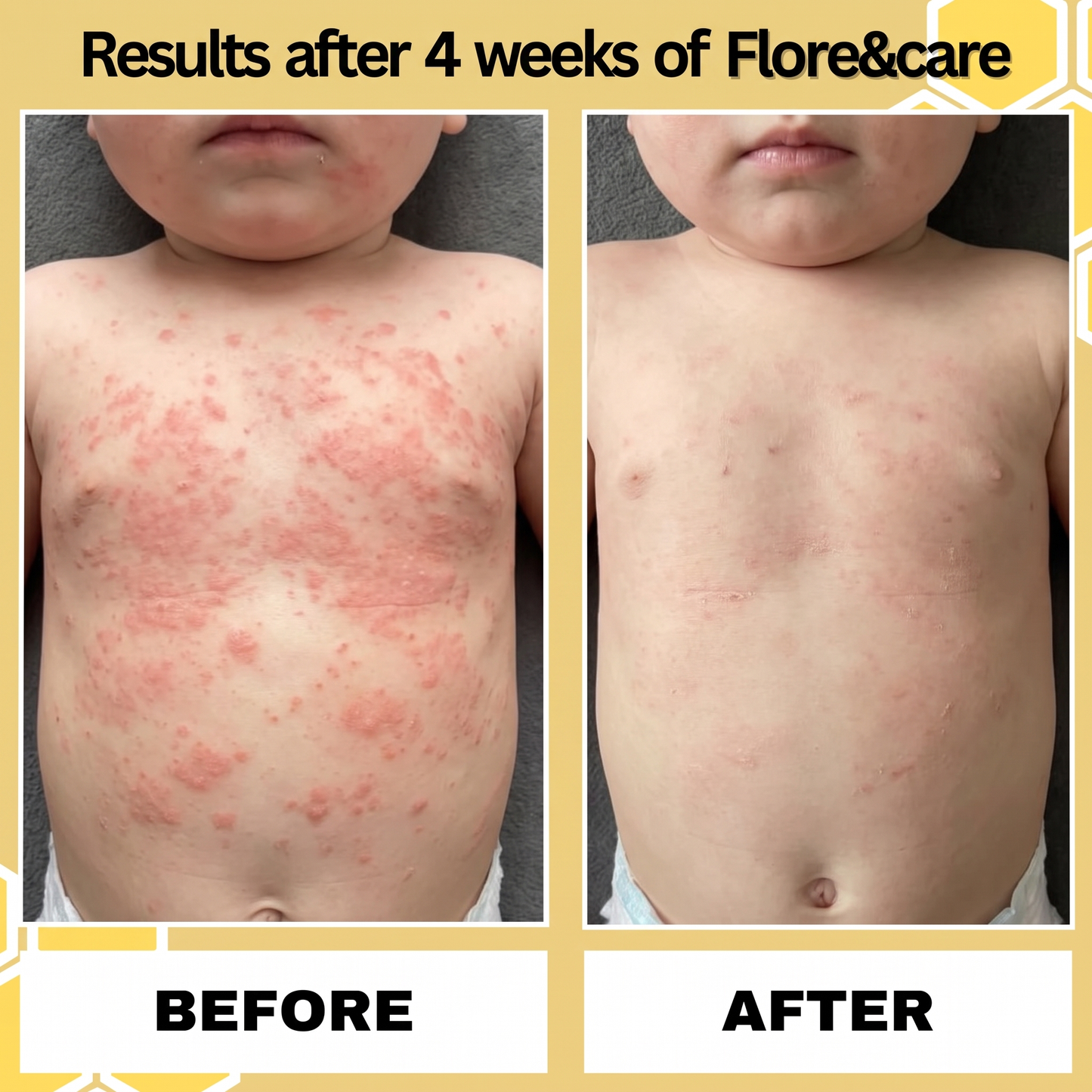 Eczema Honey Original Skin-Soothing Cream